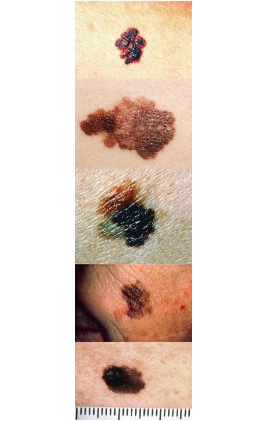 A column of pictures showing examples of the ABCDEs of melanoma